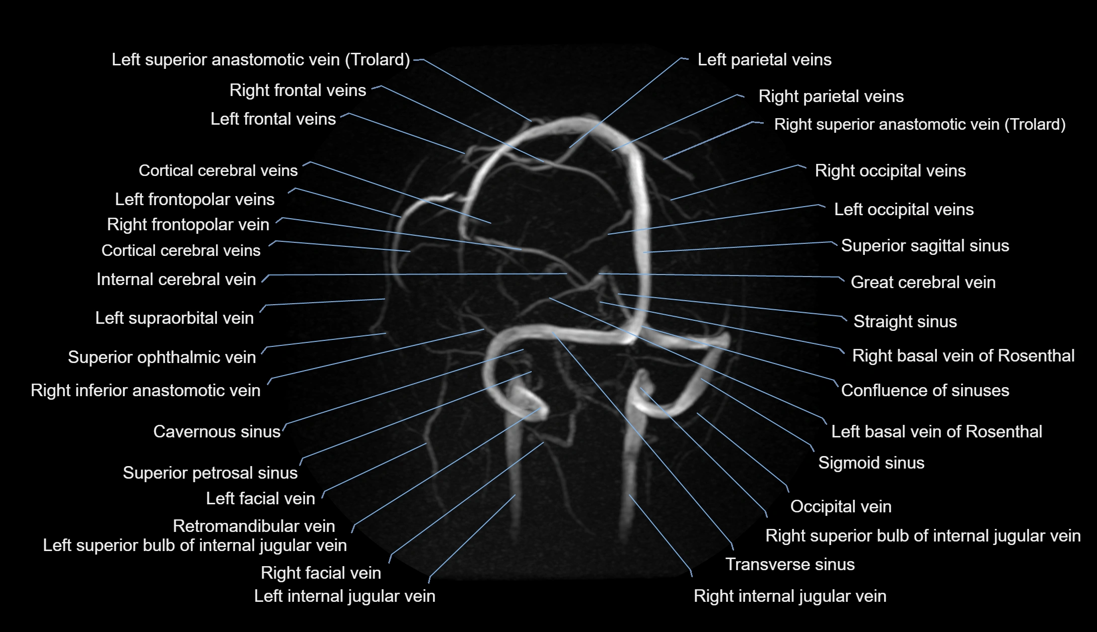 MRV brain MIP sagittal labelled anatomy 3T MRI images -img-1011001-00009.webp